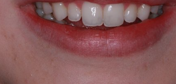 After Invisalign treatment