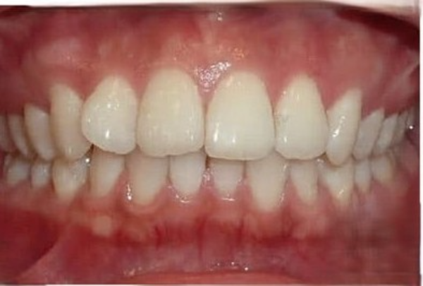 Before Invisalign treatment