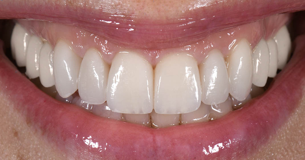 After porcelain veneers