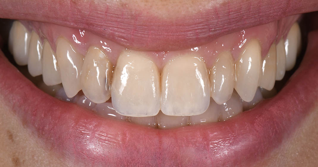 Before porcelain veneers