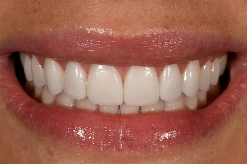 After teeth whitening